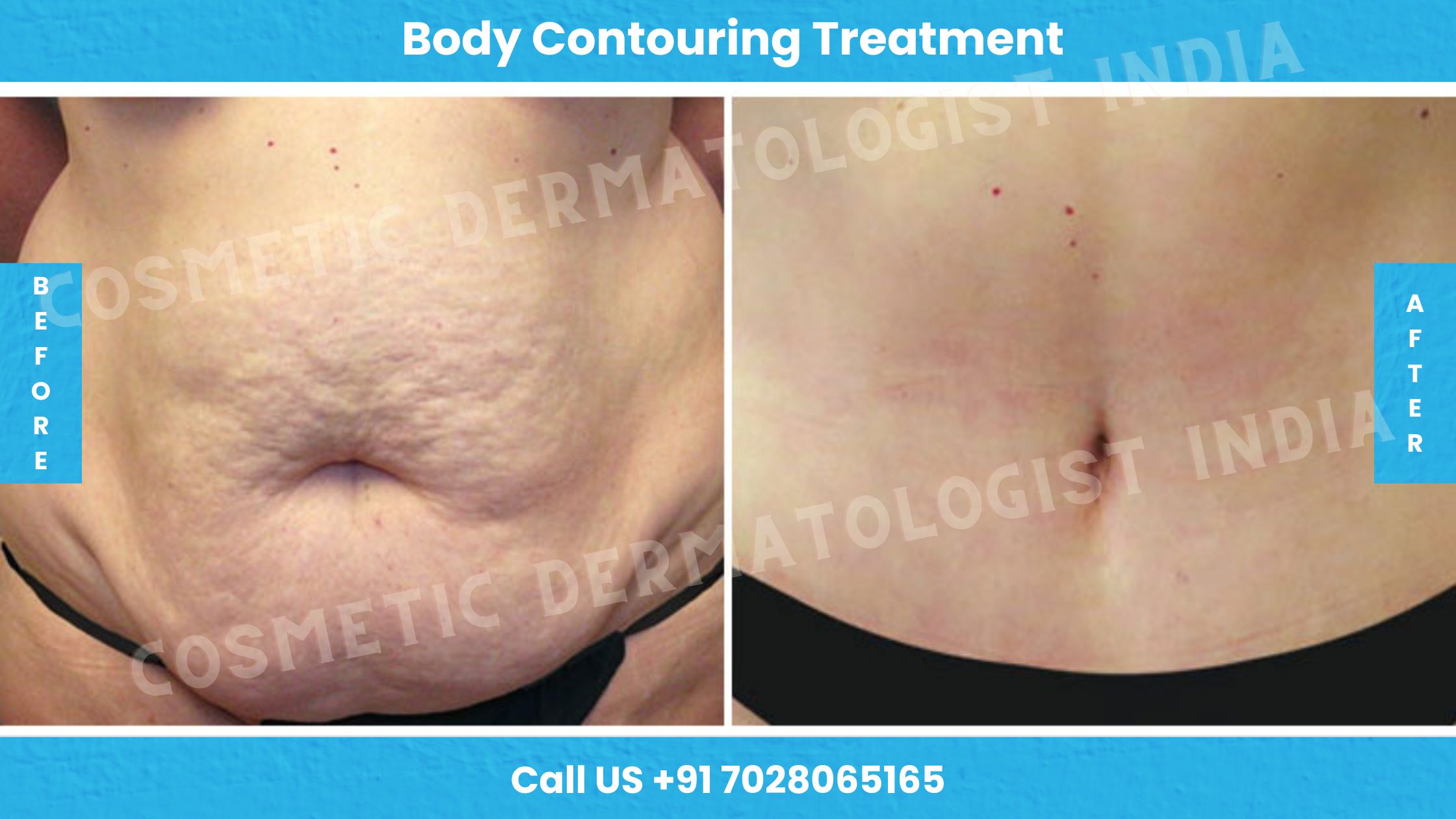Body Contouring Treatment Mumbai- Non Surgical Body Contouring