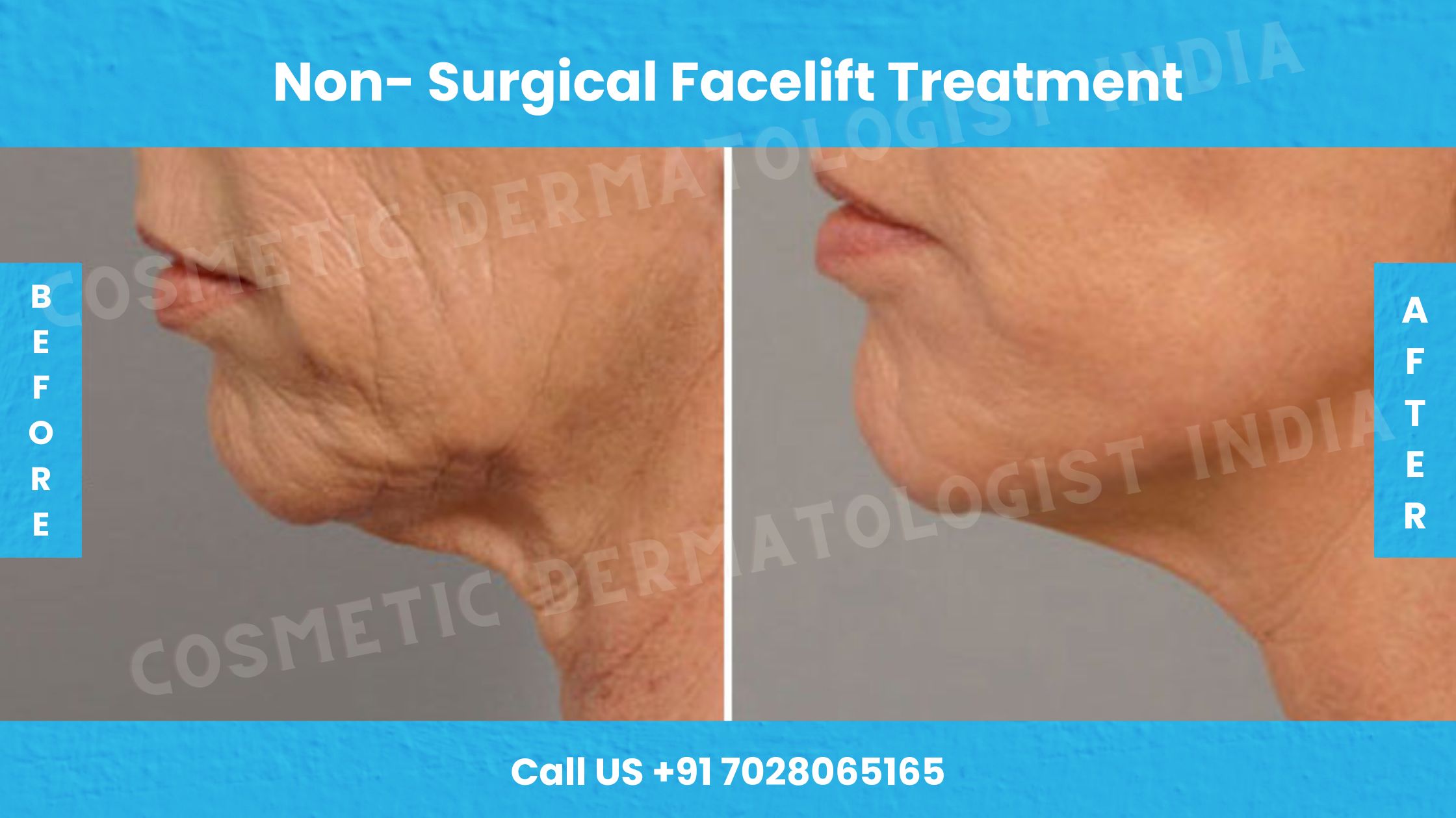 Non-Surgical Facelift Treatment Mumbai- Facelift Treatment, Cost
