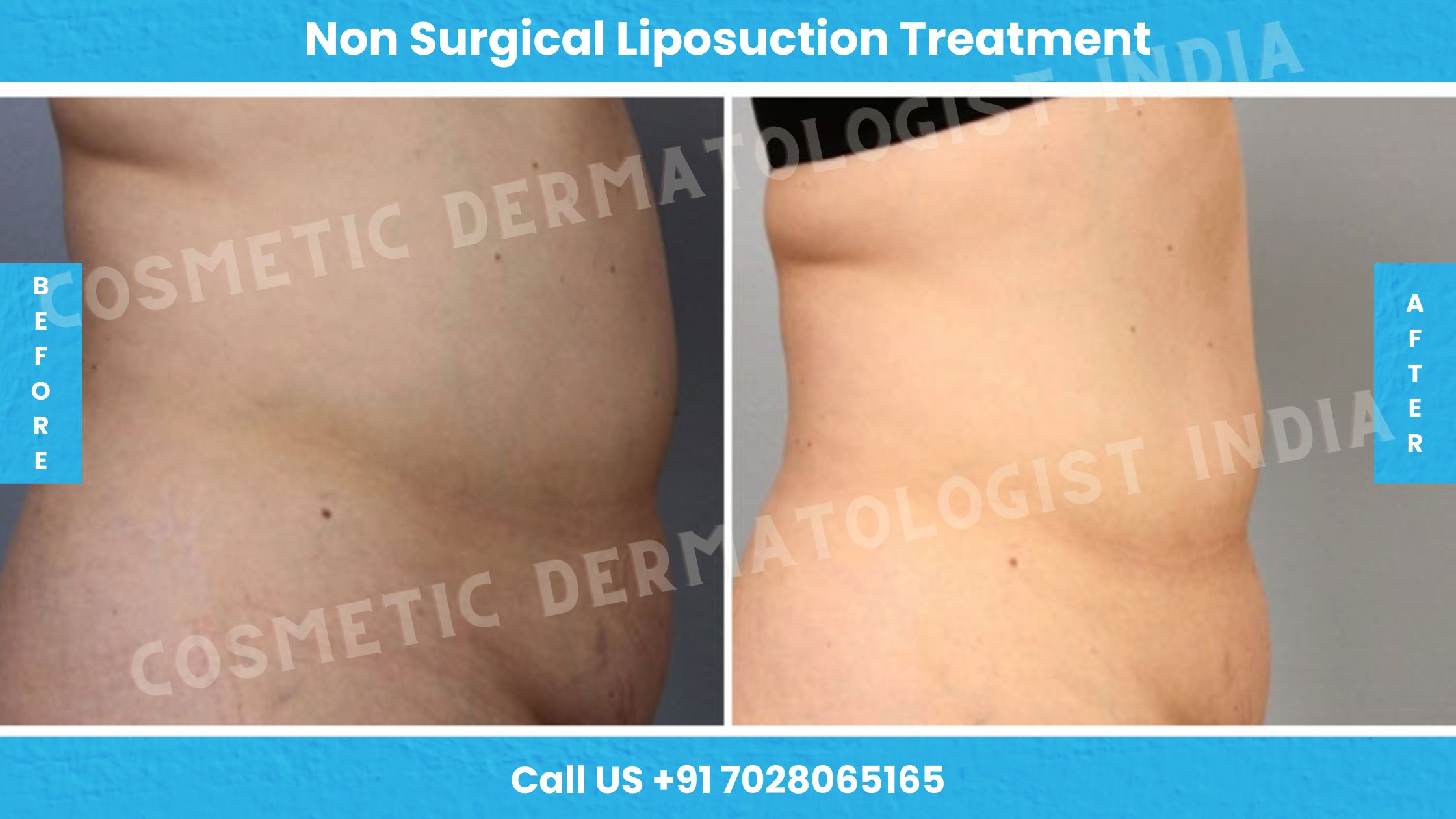 Non-Surgical Laser Liposuction Treatment Cost in Mumbai, India