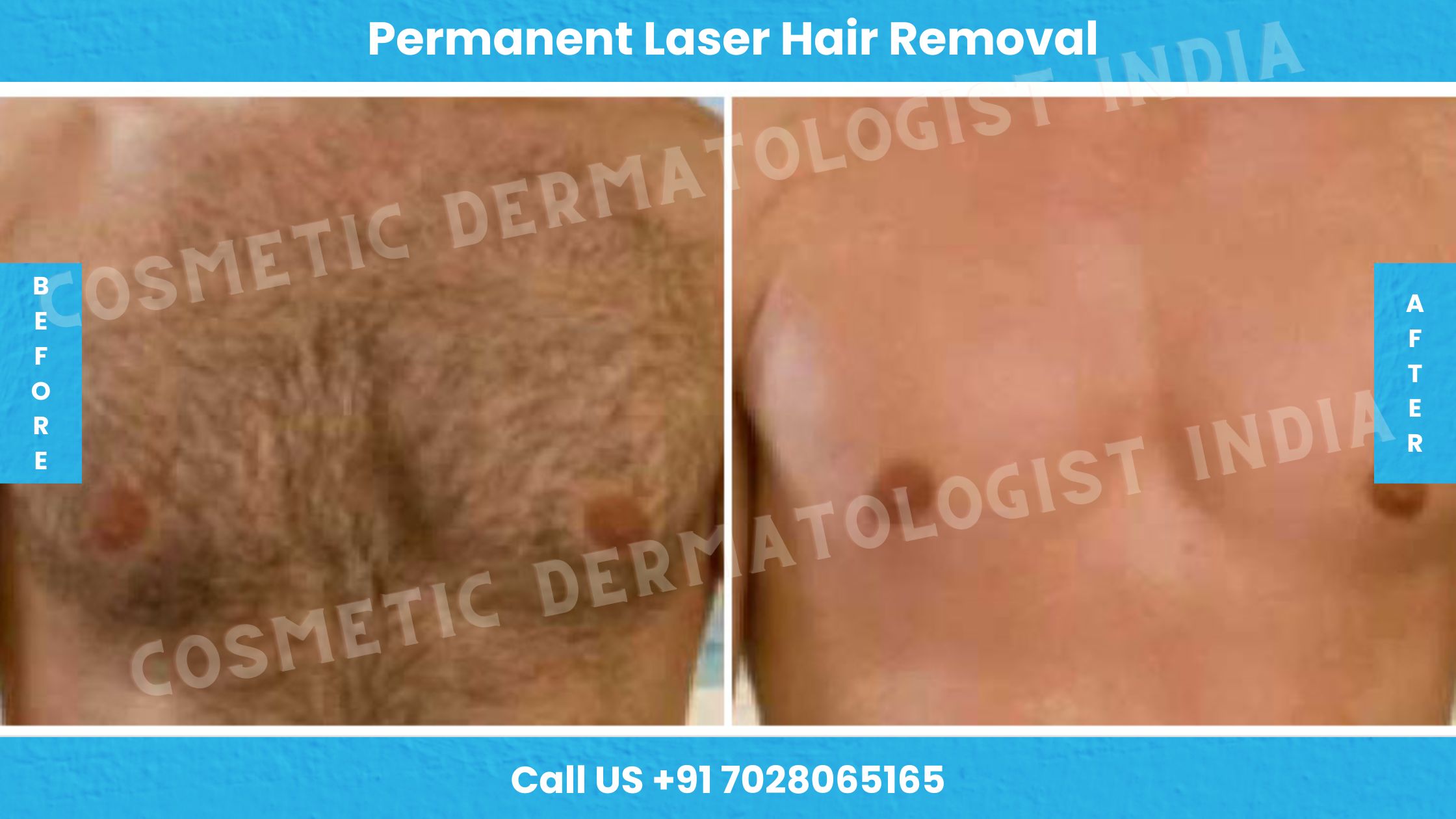 Mens Before  After Photos of Laser Hair Removal  Milan Laser in  Baltimore MD
